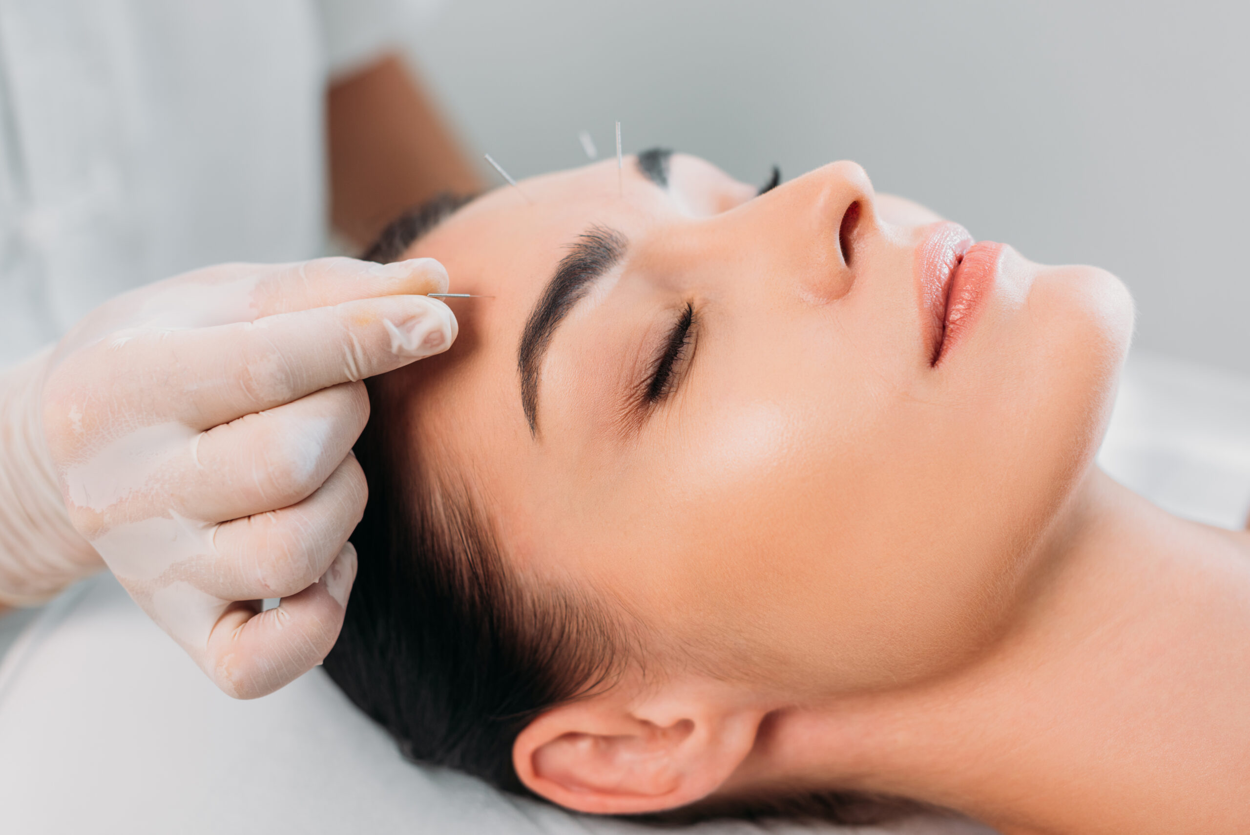 Cosmetic Acupuncture